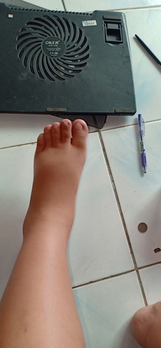 เท้าบวม