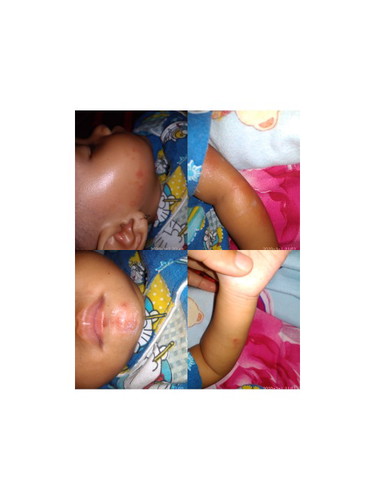 bukan herpes tapi infeksi kulit