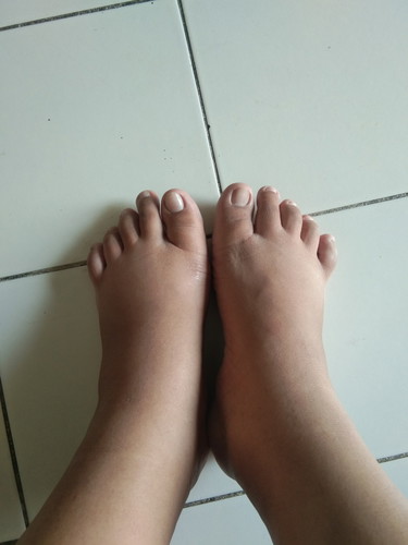 ขาบวม