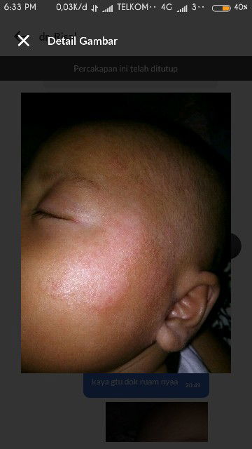 ruam pada bayi
