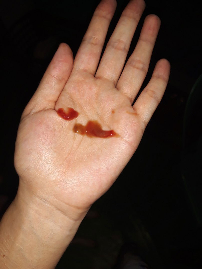 Mucus plug or normal after IE?