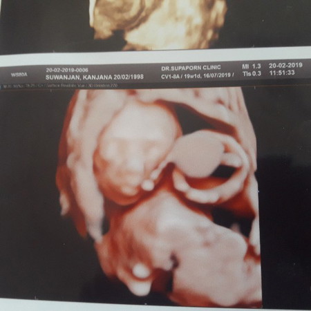 ทารกในครรภ์ ผนังหน้าท้องไม่ปิด