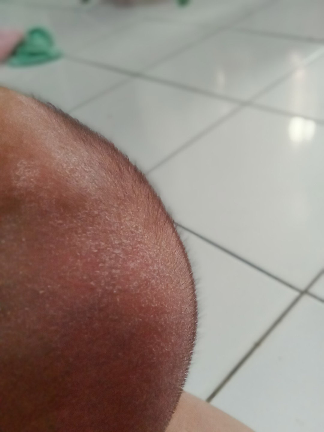 kulit kepala kering