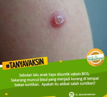 bekas imunisasi ank