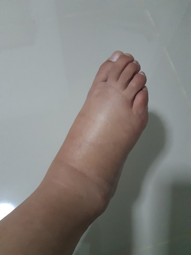 เท้าบวม