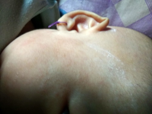 Bintik Bintik Pada Bayi