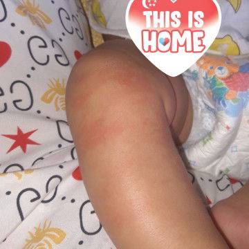 bé nổi mẩn đỏ