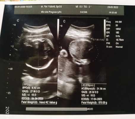 Alhamdulillah, Baby Girl 27w5d