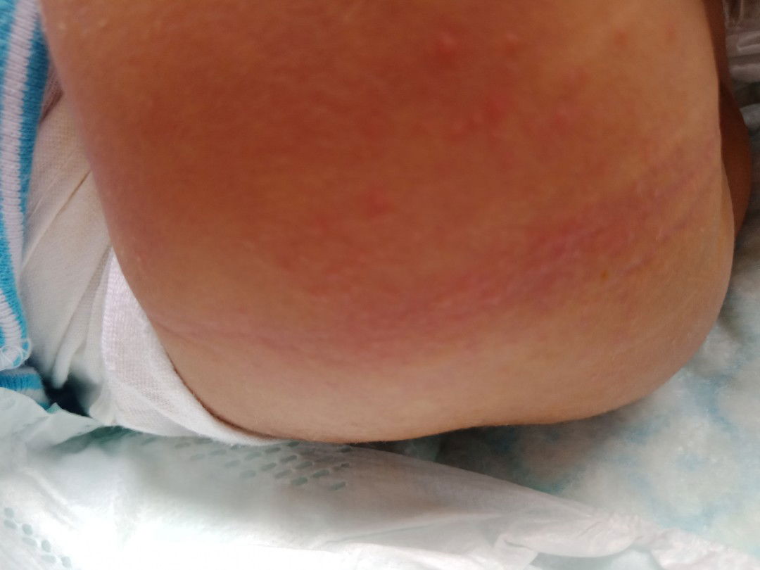 rashes ni baby