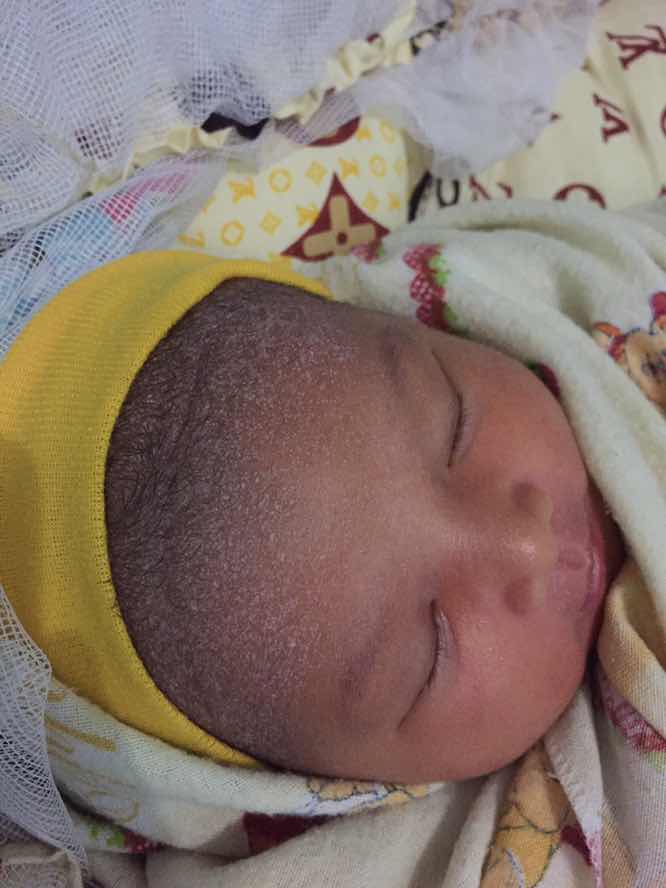 Biang keringat putih