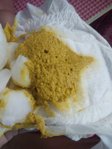 น้องทานนมแม่ด้วย นมผงด้วย ถ่ายแบบนี้ปกติไหมค่ะ