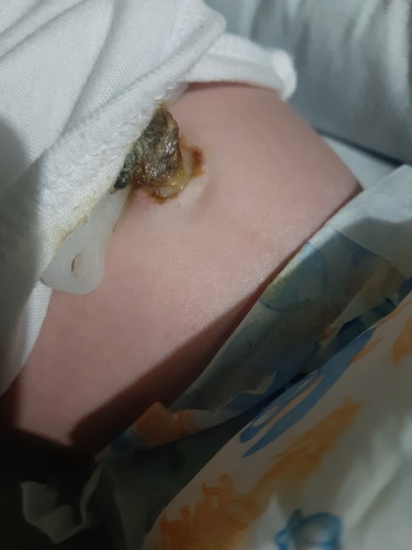 Umbilical cord..