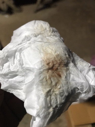 ท้อง 7 สัปดาห์ มีเลือดสีน้ำตาลซึมออกมา