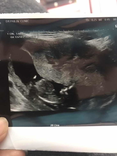 แม่ๆค่ะ ขอดูภาพอัลตร้าซาวด์น้องตอน 12 วีคหน่อยค่ะ