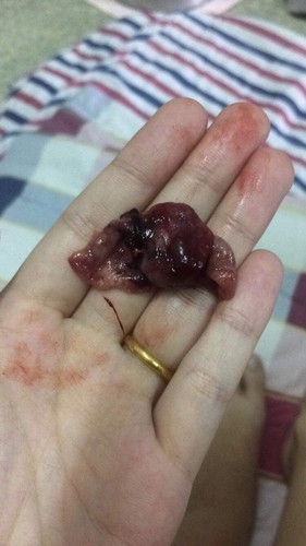 ตั้งครรภ์ได้ 6 week แล้วปวดท้องตลอดเวลามีเลือดออกเหมือนประจำเดือน พอไปหาหมอ หมอก็แค่อัลต้าซาวให้ แล้วนัดวันมาอีกที แต่วันนี้ปวดท้องหนักมาก