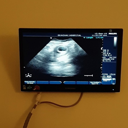 ประสบการณ์การของคุณแม่ที่เคยแท้ง...