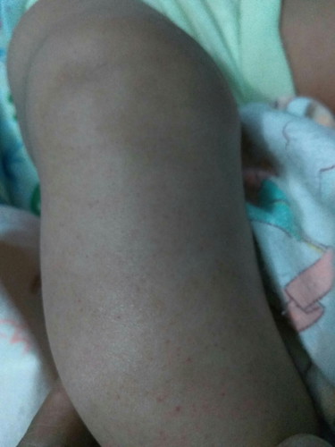 bintik2 merah pada kulit bayi usia 4 bulan