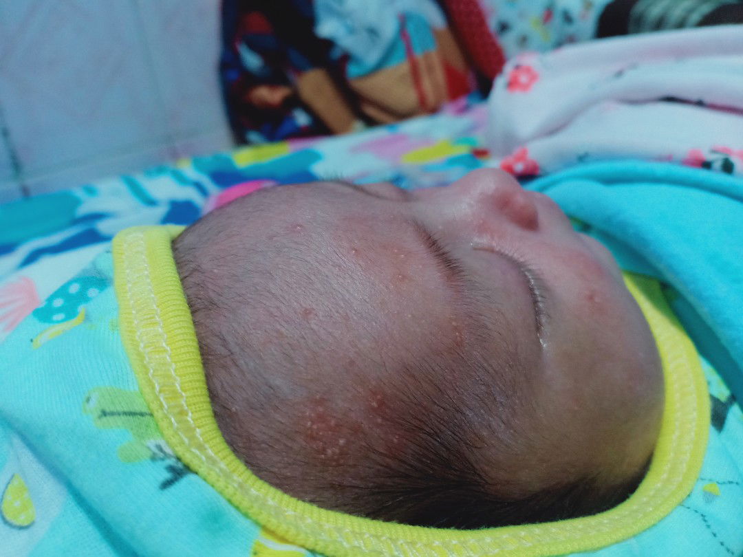 bintik pada muka bayi