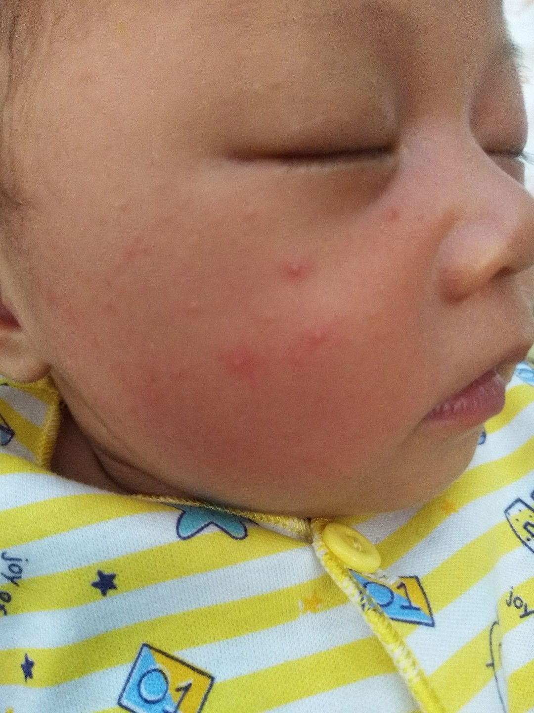 Bintik merah dwajah, badan dan kepala