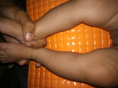 kaki bayi ngga lurus