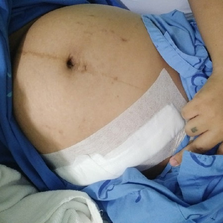 30w5d มาผ่านิ่วถุงน้ำดี