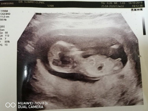 เพศลูก