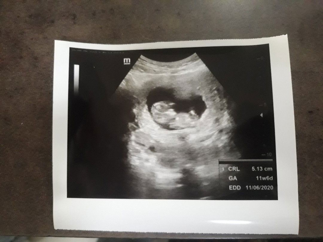 Usg ke 2 bulan ini 12week