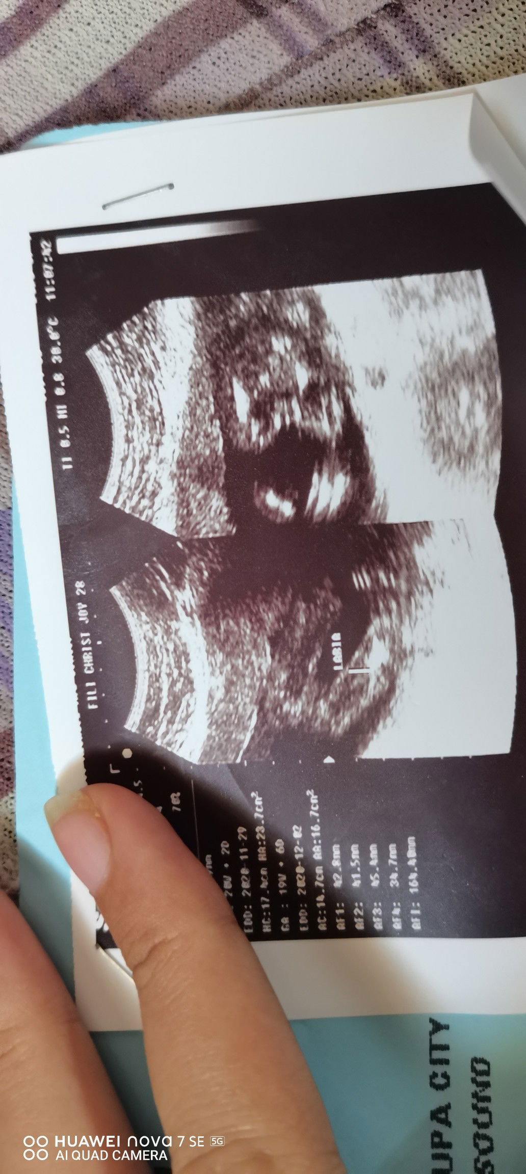 Girl Po Ba Or Boy Si Baby Kse LABIA lang Po Nilagay