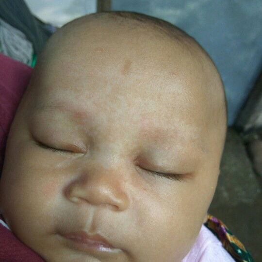 area dahi berwnra bercak putih