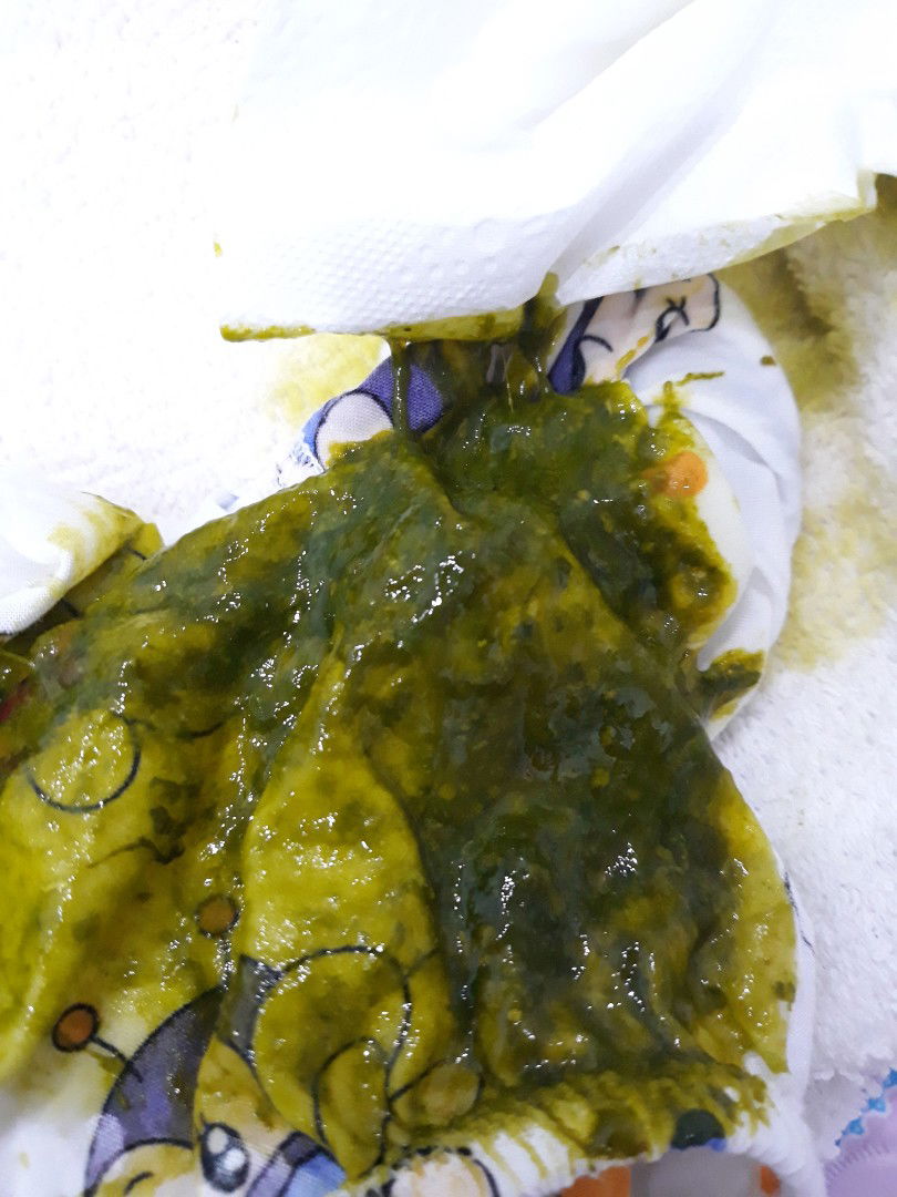 bé 4 tháng 10 ngày sốt