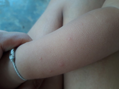 น้องถูกตัวอะไรกัด?