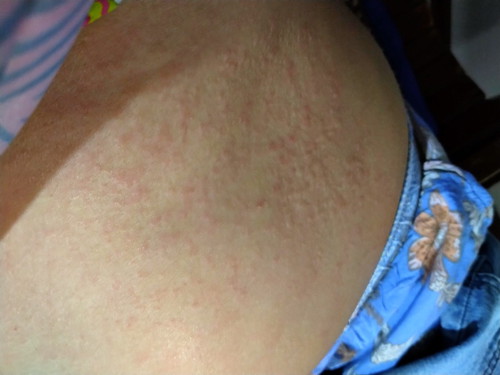 ท้องเป็นผื่น