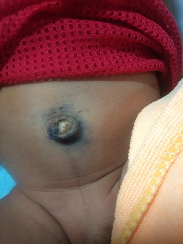 สะดือหลุด