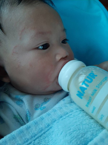 ผื่นแดง