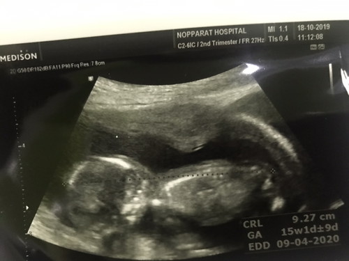 เอารูปอัลตร้าซาวด์มาให้ดูค่ะ