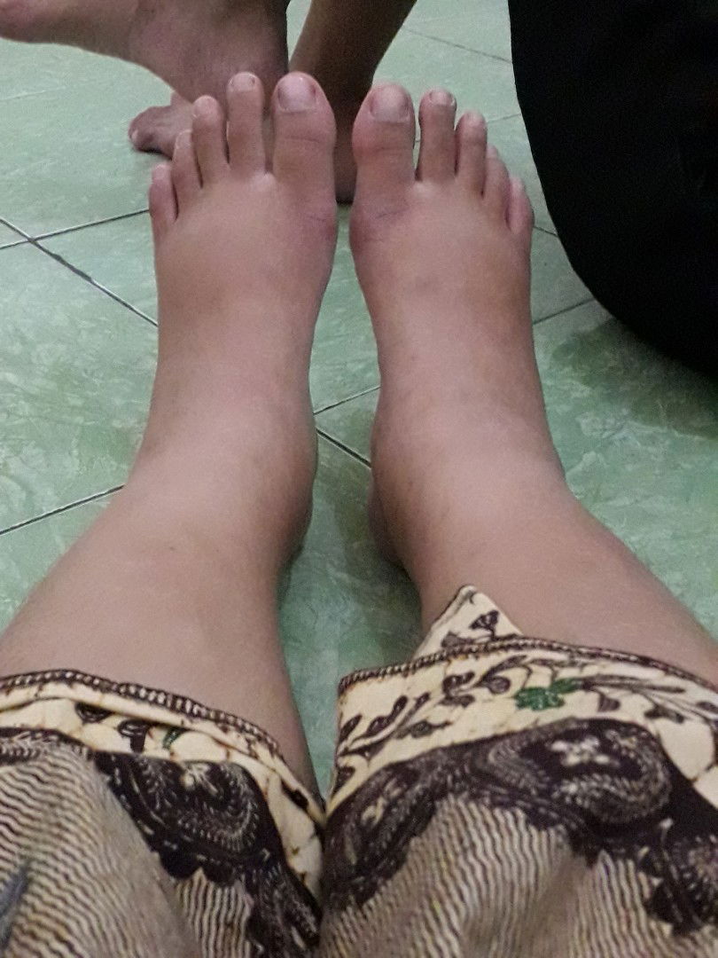 kaki bengkak