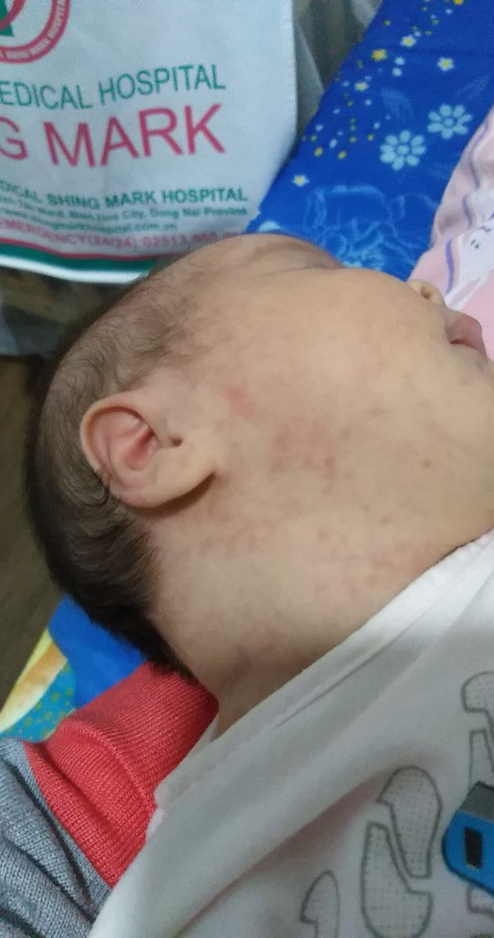 bé bị nổi đỏ