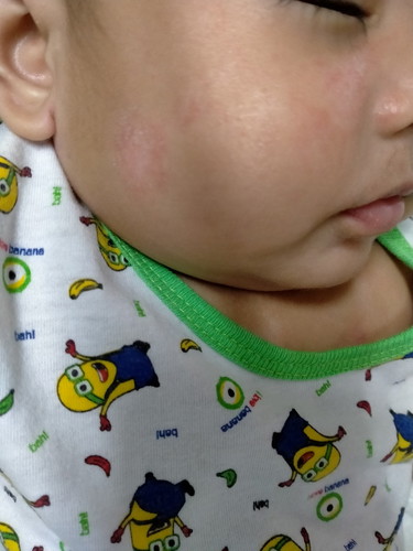 rashes
