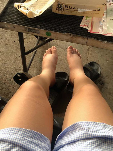 เท้าบวม