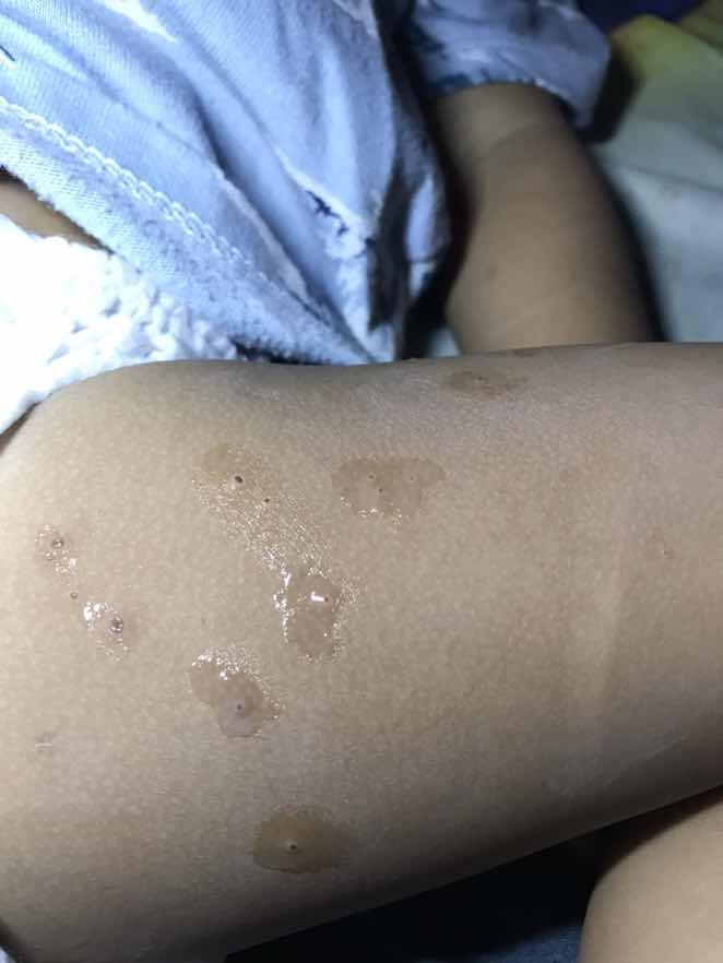 Bintik hitam pada kulit bayi