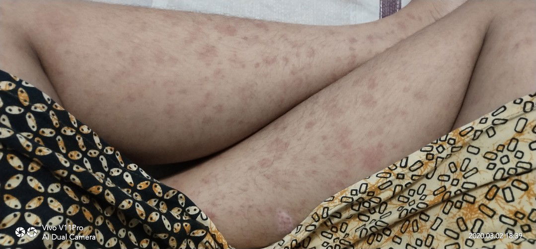 Alergi atau Bawaan Hamil ?