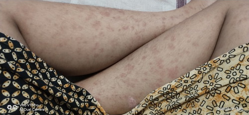 Alergi atau Bawaan Hamil ?