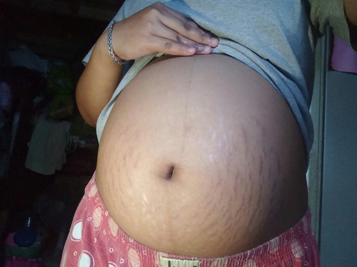 แม่ๆค้ะใครท้องแตกแบบบ้านนี้บ้าง