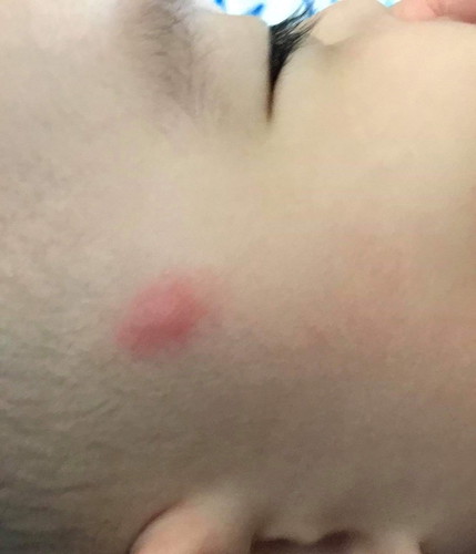 Insect bite