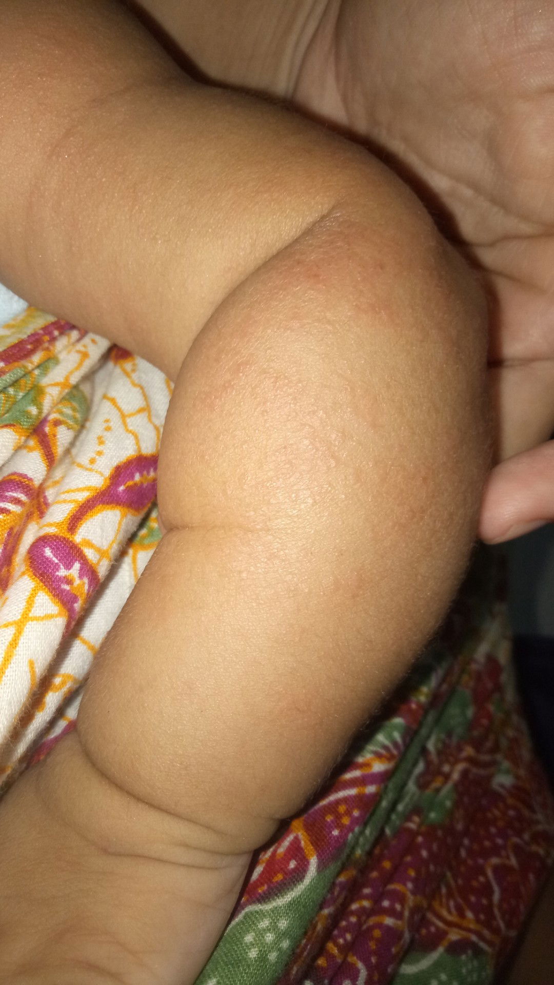 alergi atau biang keringat?