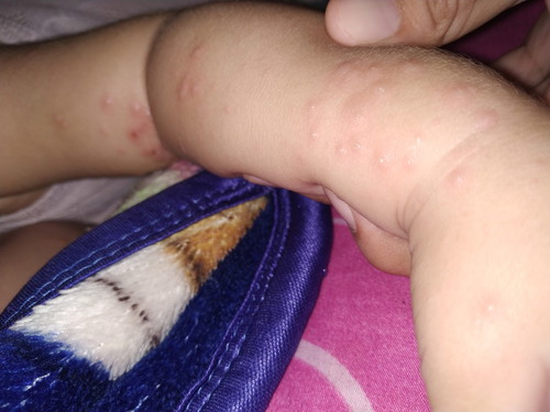 berawal panas tinggi