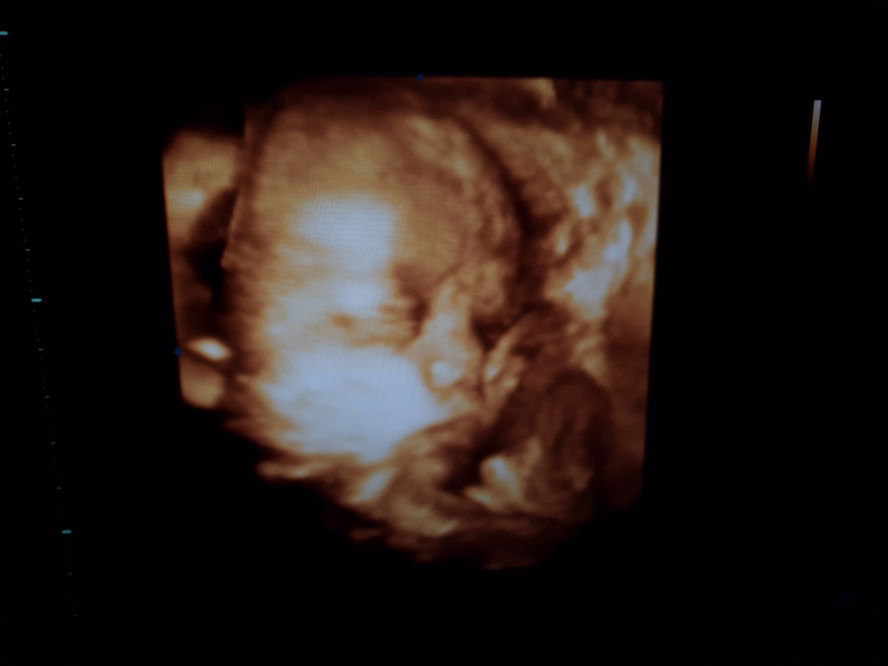 อัลตร้าซาวด์