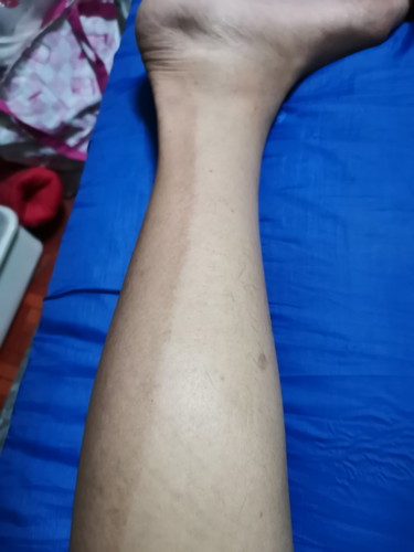 เป็นแบบนี้ที่ขา คืออะไรคะ (โรคร้ายแรงรึป่าว)