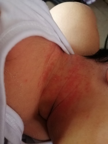 Rashes