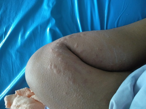 หลังผ่าคลอด